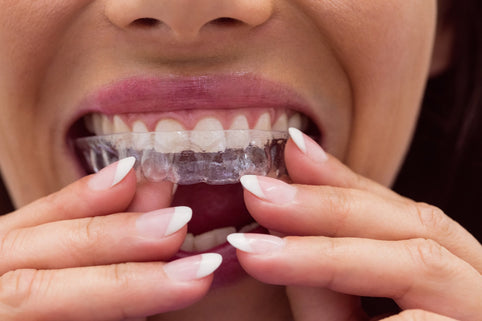 Lingualtechnik vs. Aligner